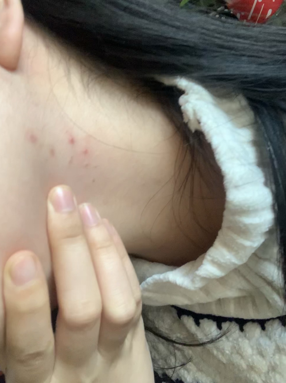 有没有人知道这是咋回事脖子为啥长痘 不痒