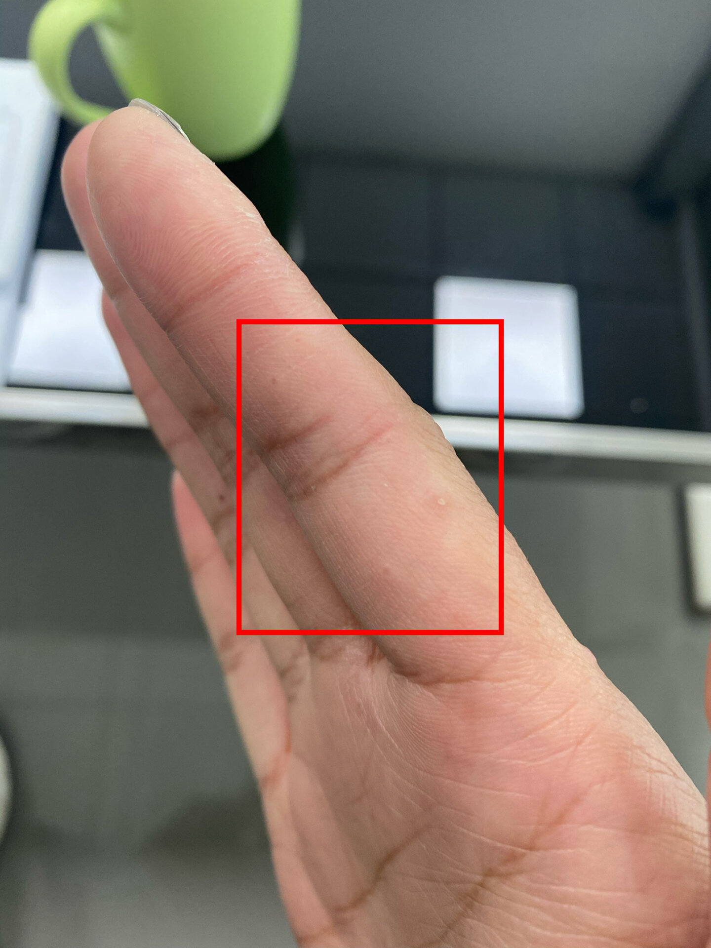 手上最近长了好几个这种小疙瘩