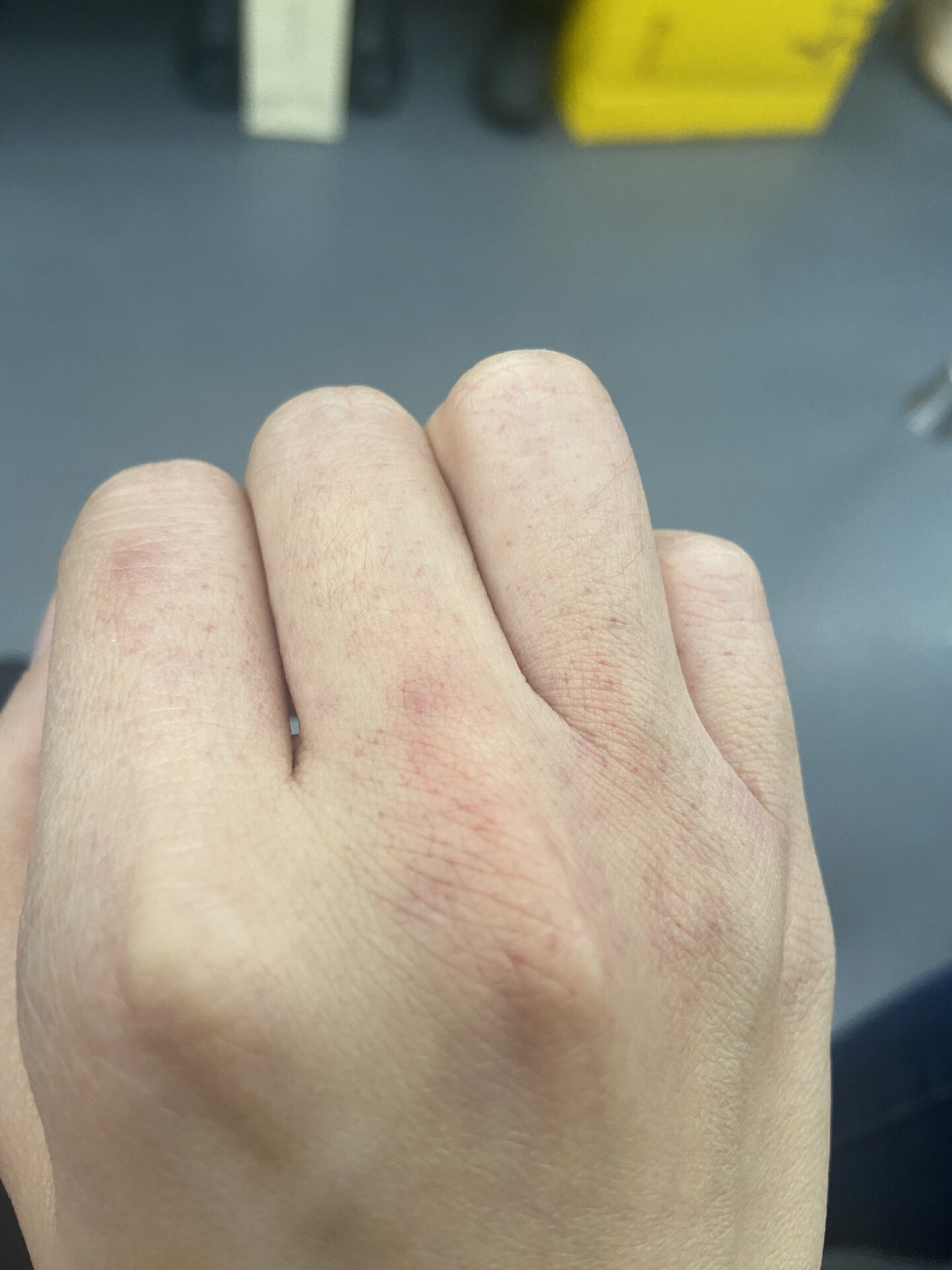 昨天下班手背上突然出现这种小红点,不痛不痒,就一只手上有,然后晚上