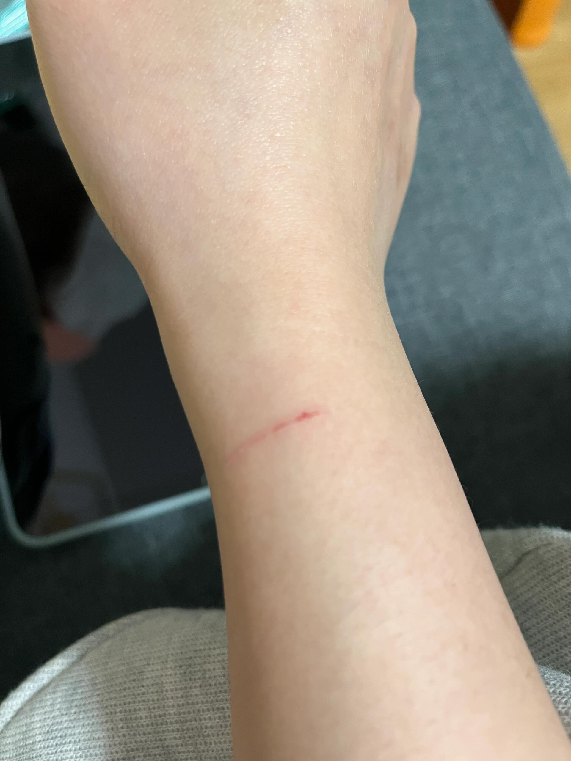 被三个月的猫挠了要打针吗?