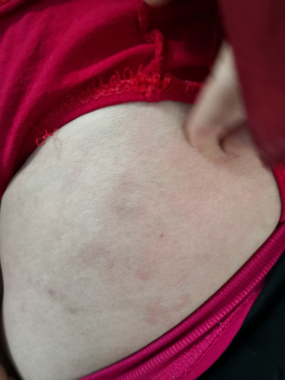 躯干四肢散发红斑风团症状.是荨麻疹症状#过敏##荨麻疹