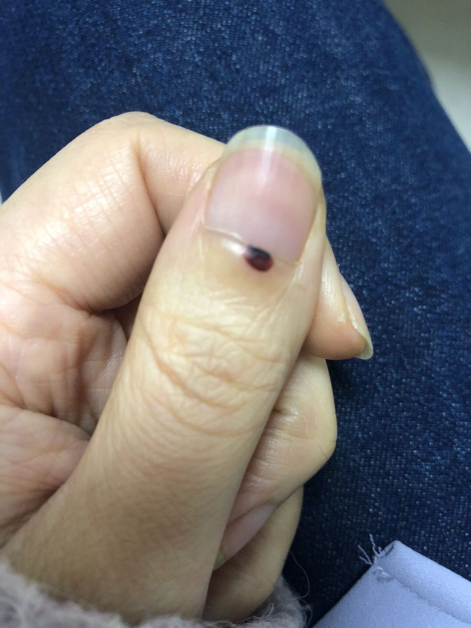 前段时间刮大风,关门的时候,手指头被门挤了个血泡,说不能挑破要冷敷