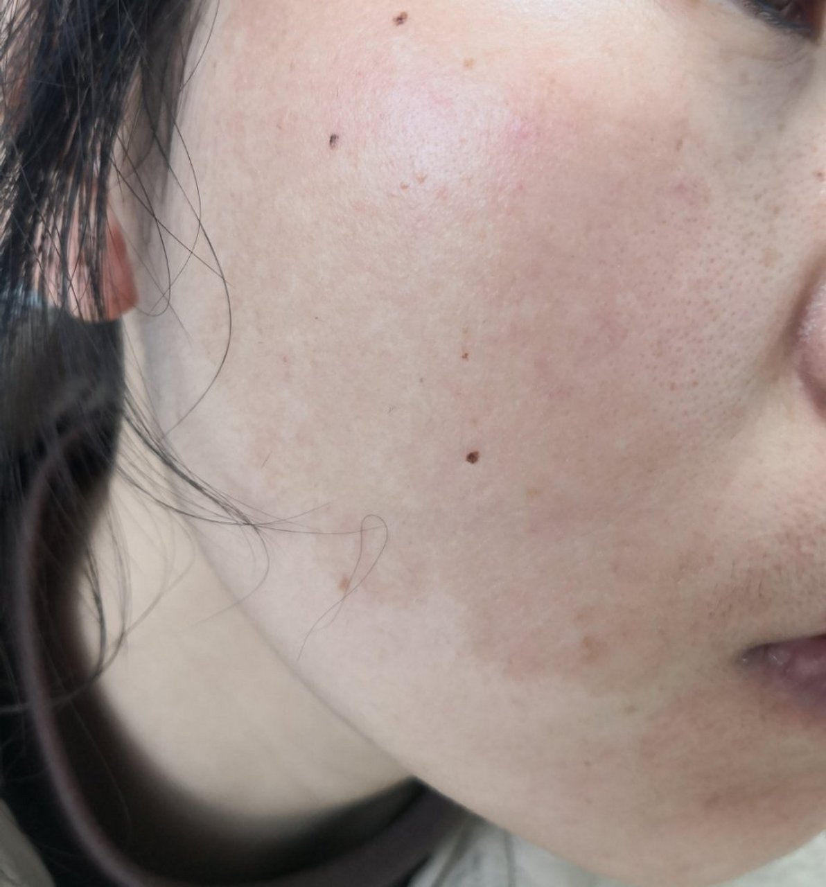 边界清楚.诊断黄褐斑.可以使用药物配合理疗治疗.