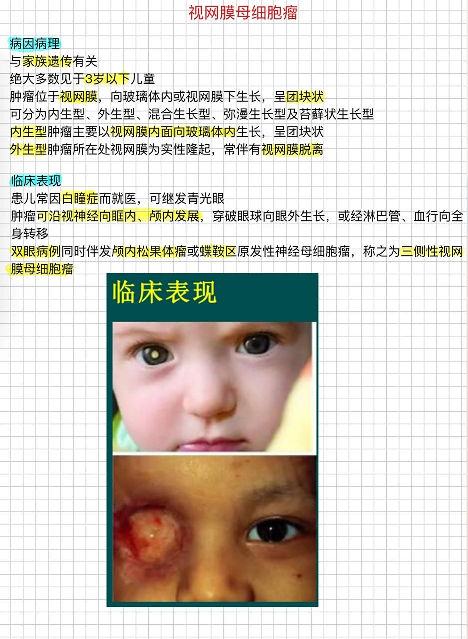 脉络膜黑色素瘤&视网膜母细胞瘤