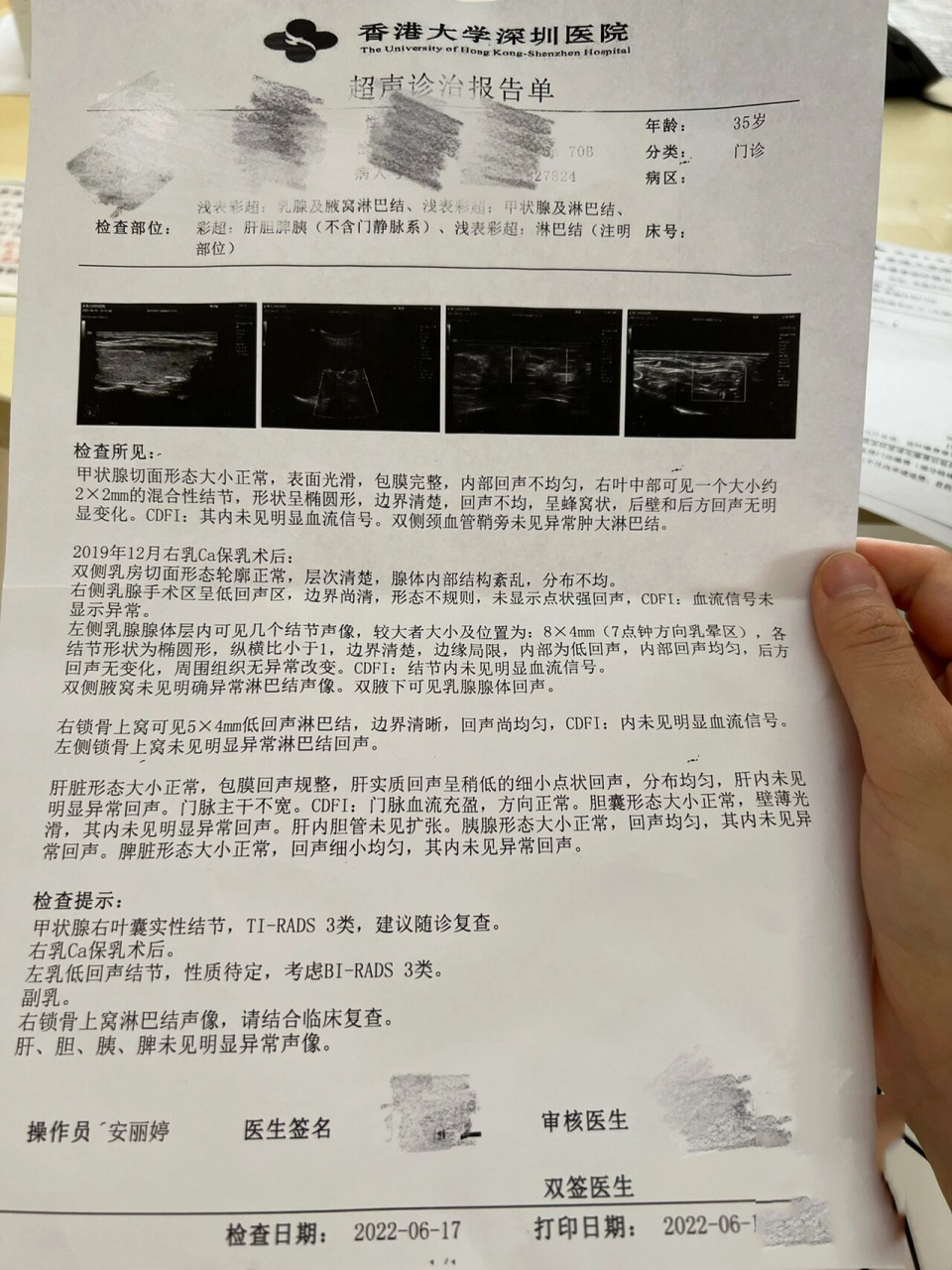 乳腺癌二年复查右上锁骨淋巴结结节 今天去复查突然发现的右上锁骨