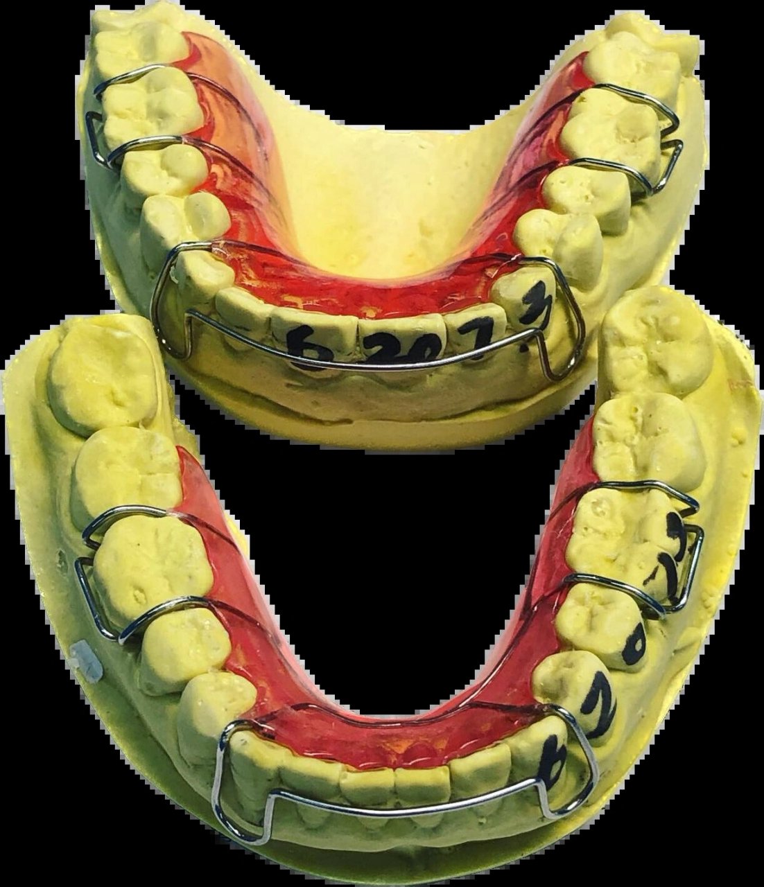 哈雷保持器(粉红色) 平常有人问,哈雷能收缝吗?
