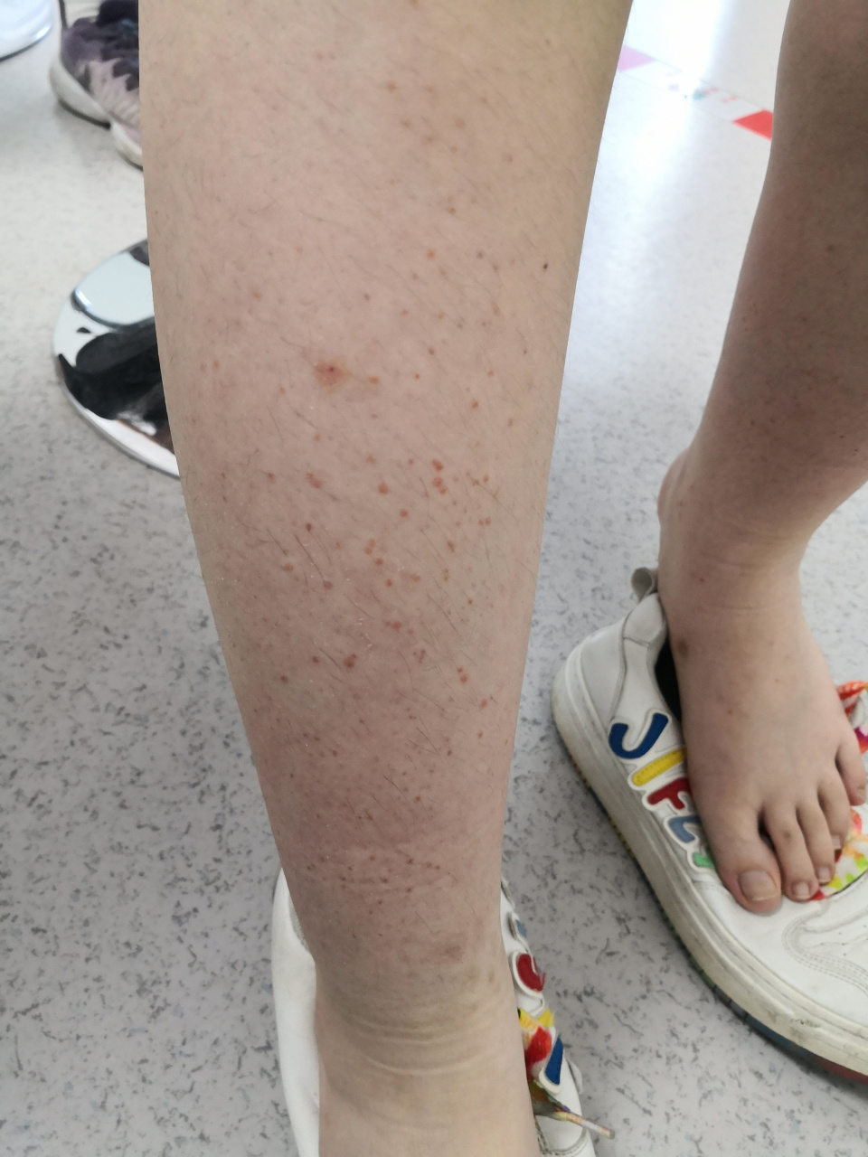 解决皮肤问题专注皮肤美容##过敏性紫癜