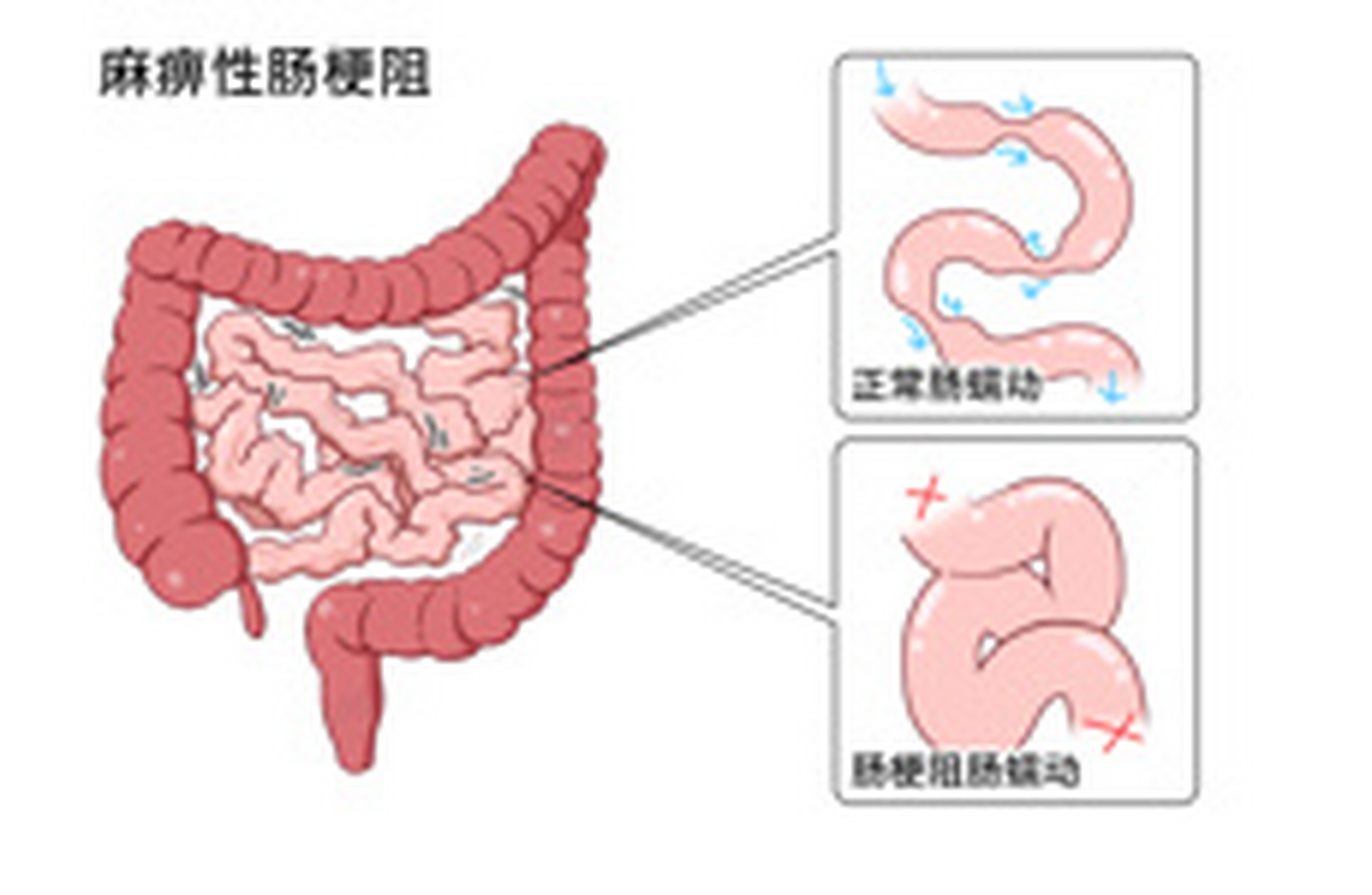 肠痉挛位置图片