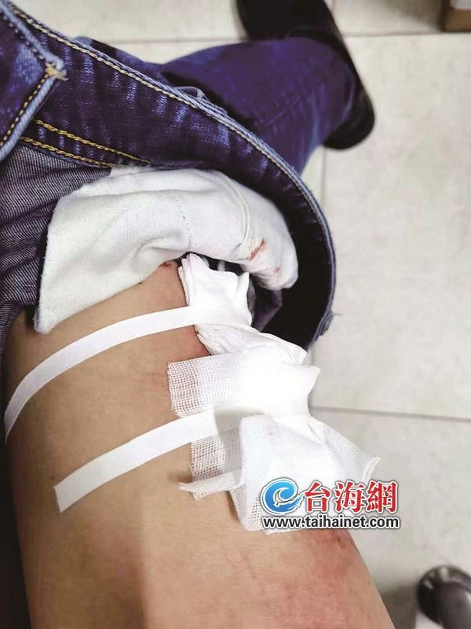 【厦门海山路一牛肉馆私开窨井盖倒污水致夜行男子掉入 大腿受伤缝了