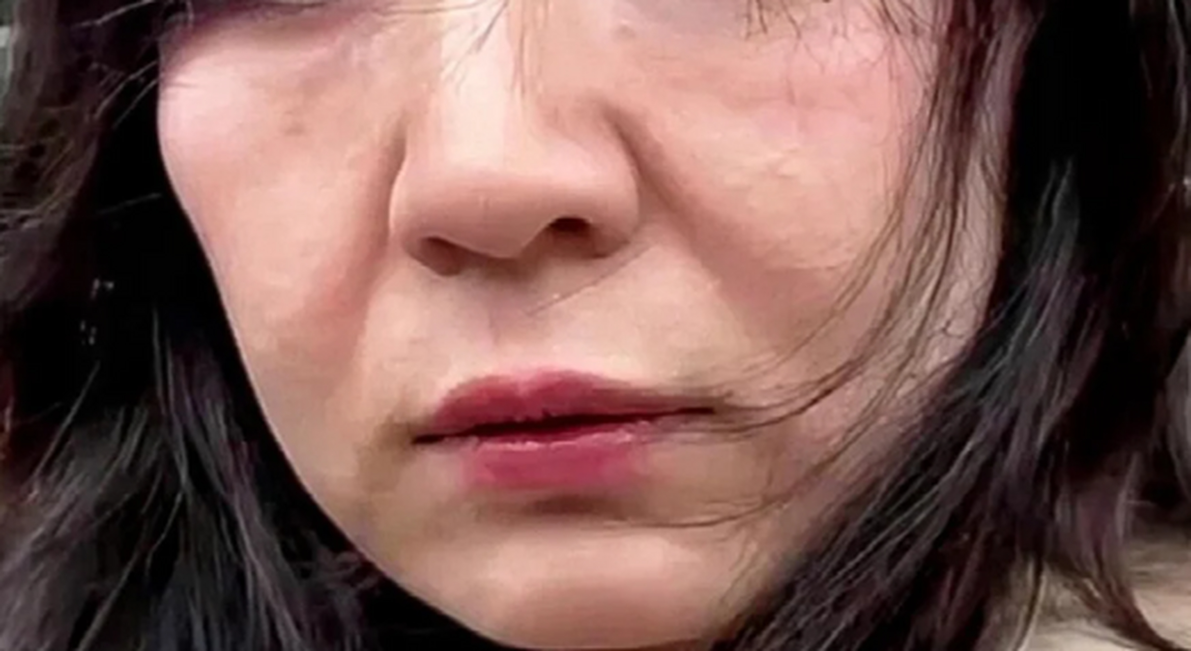 求美者情况:一位45岁的女性,面部皮肤松弛严重,尤其是中下面部,法令纹