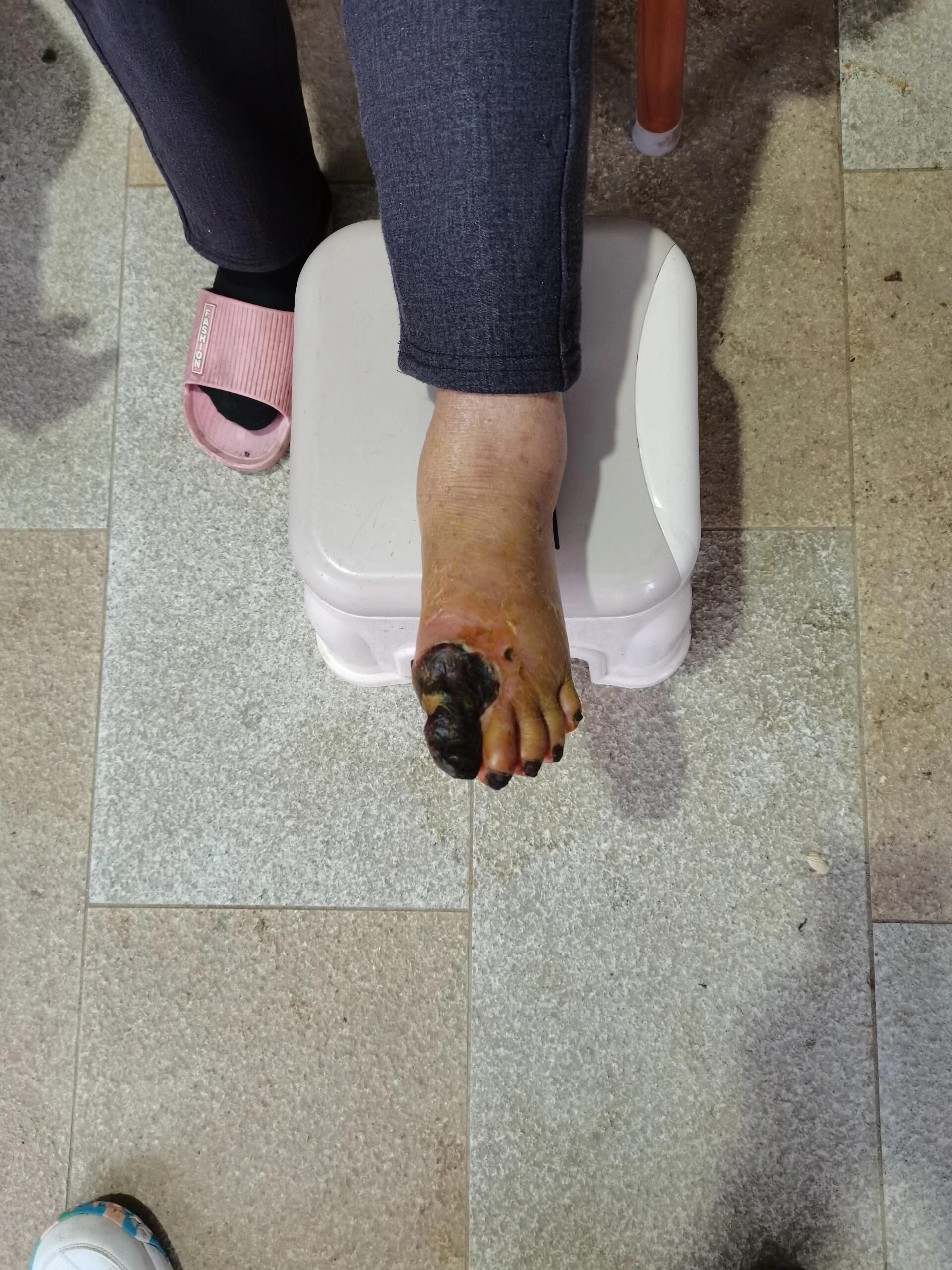 【血栓闭塞性脉管炎】持续更新
