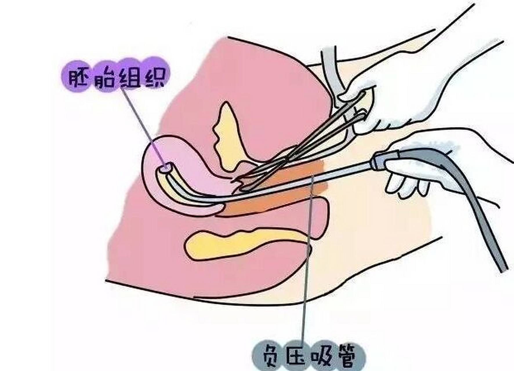 所以很多人都关心清宫手术需要多久时间,甚至想了解清宫过程真实图片