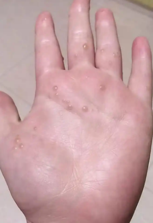 手指头上长白色的小疙瘩最常见的原因是湿疹和汗疱疹