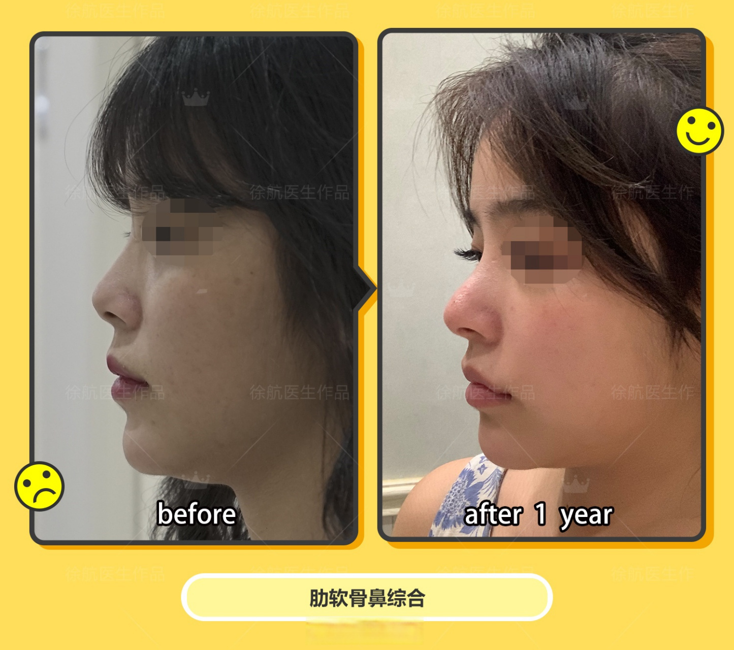 但太短也不好看,幼态感的脸延长鼻子要掌握好度,避免过长显老.