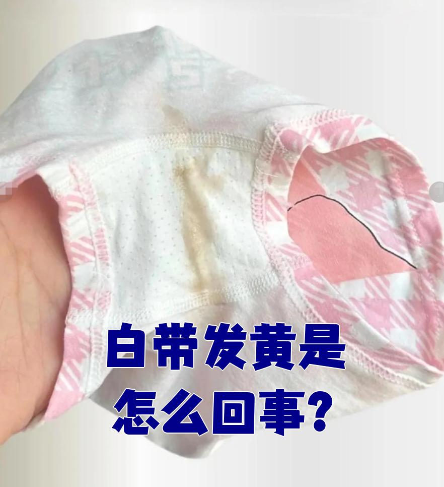 如果白带发黄,大多数时候是妇科疾病引起的,比如滴虫性阴道炎,慢性子