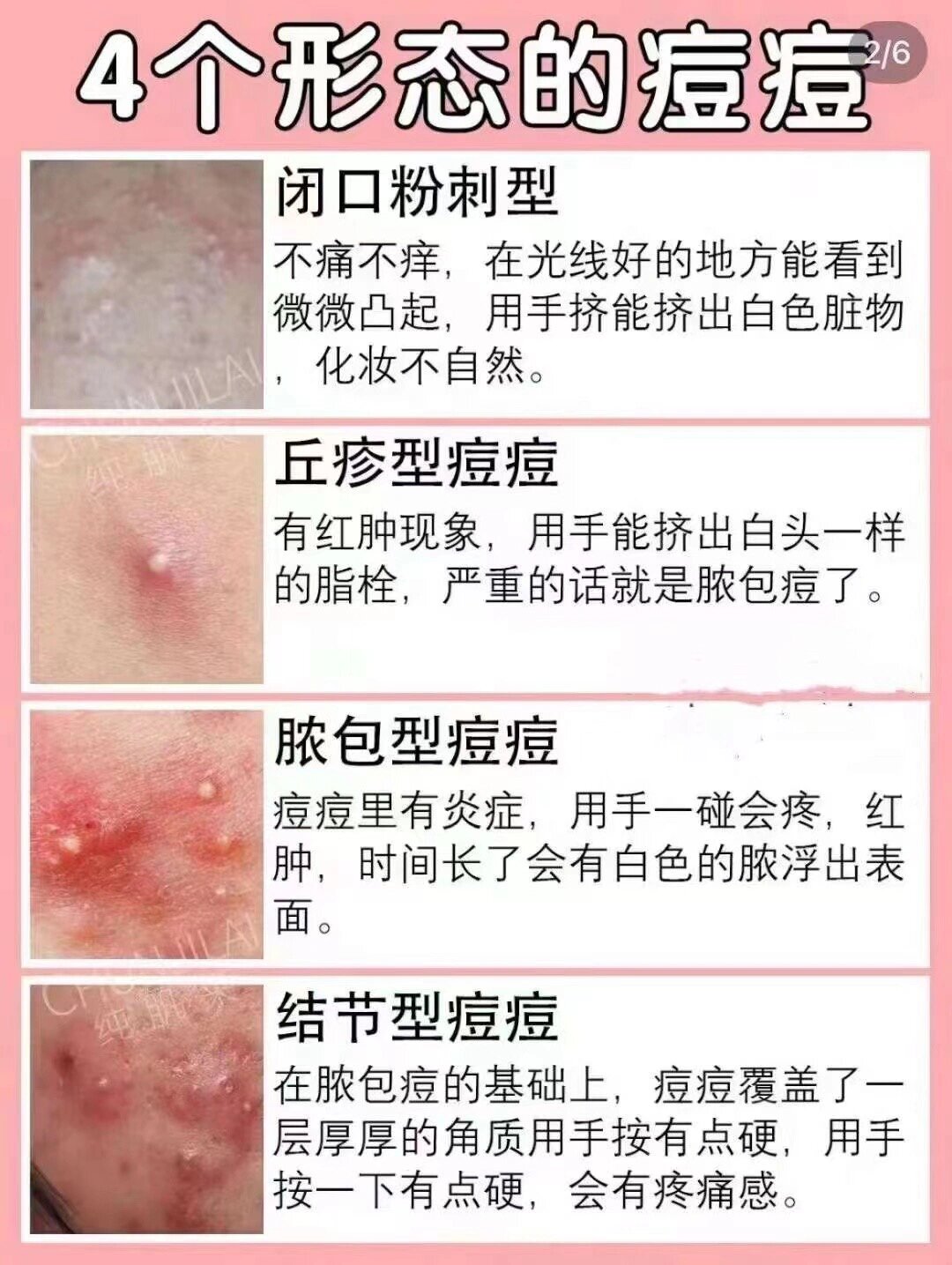 16615闭口粉刺型:不痛不痒,能看到微微凸起,挤能挤出白色脏物 2