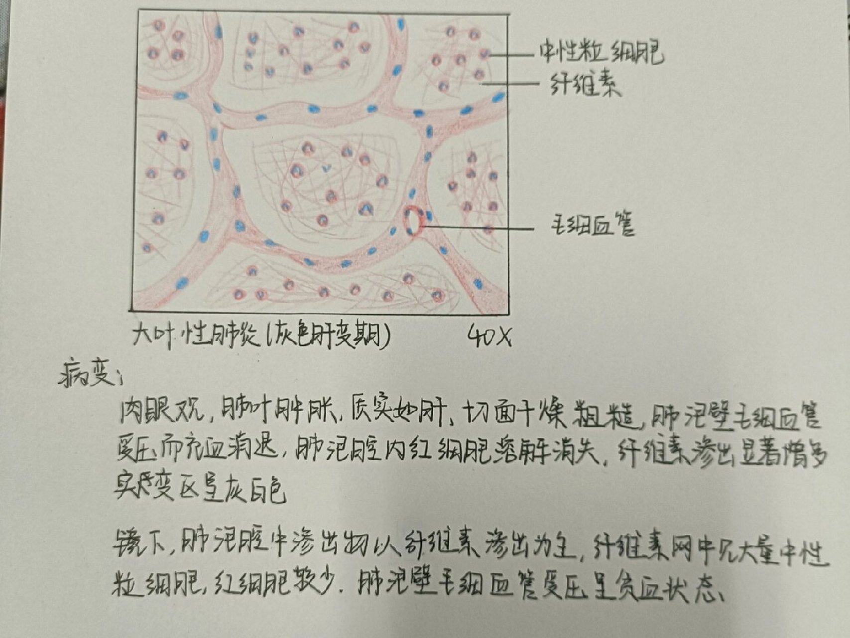 大叶性肺炎红肝期绘图图片