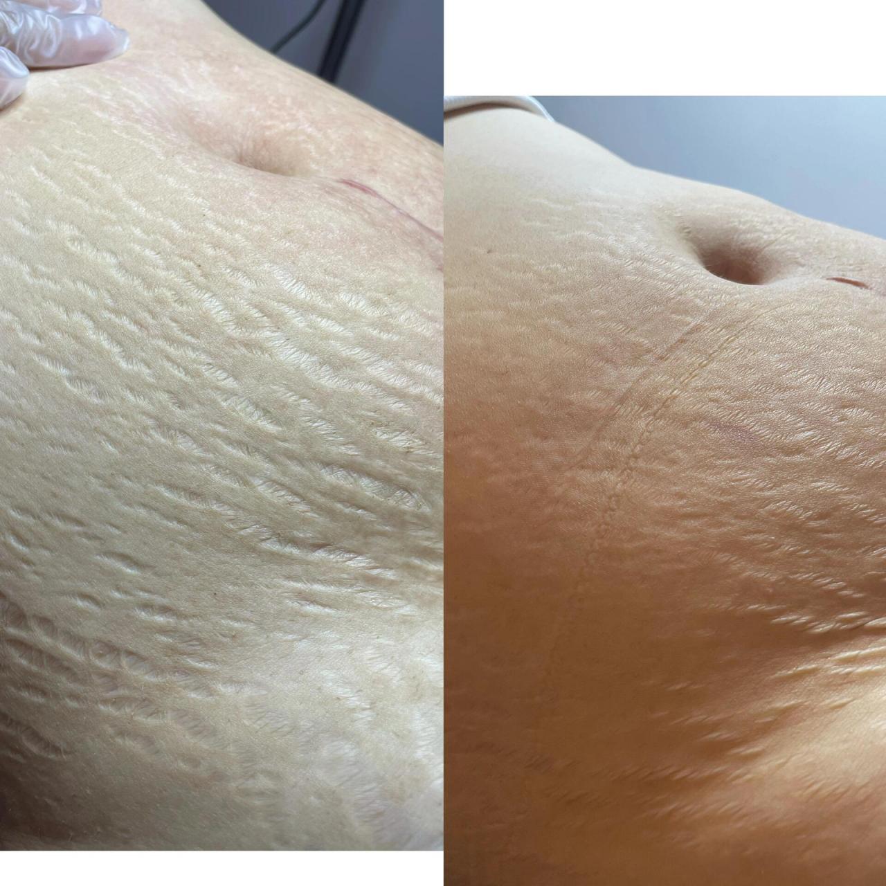 妊娠纹修复 5月份-8月份,做了三个月的效果,还可以吧