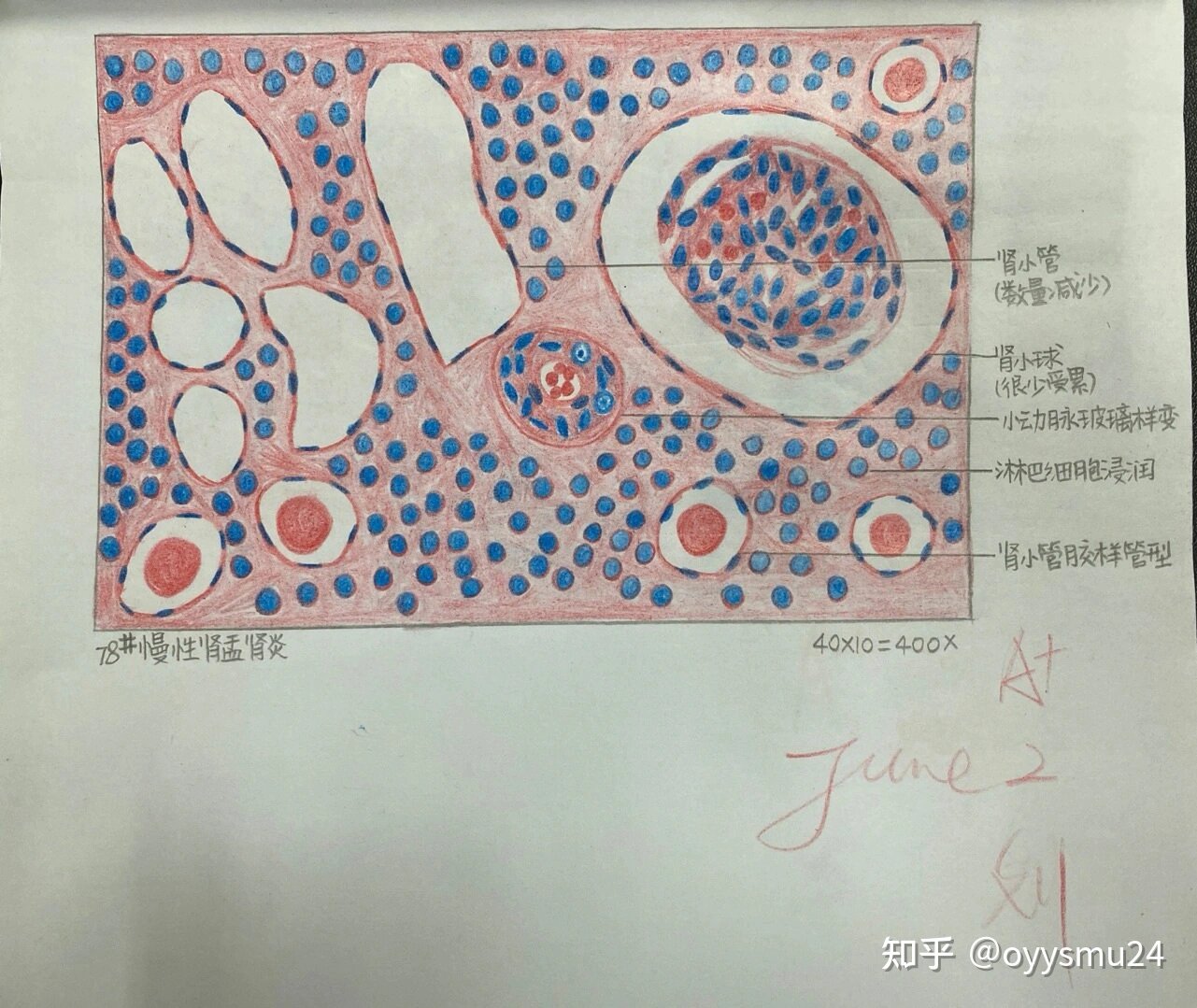 肺水肿红蓝铅笔手绘图图片