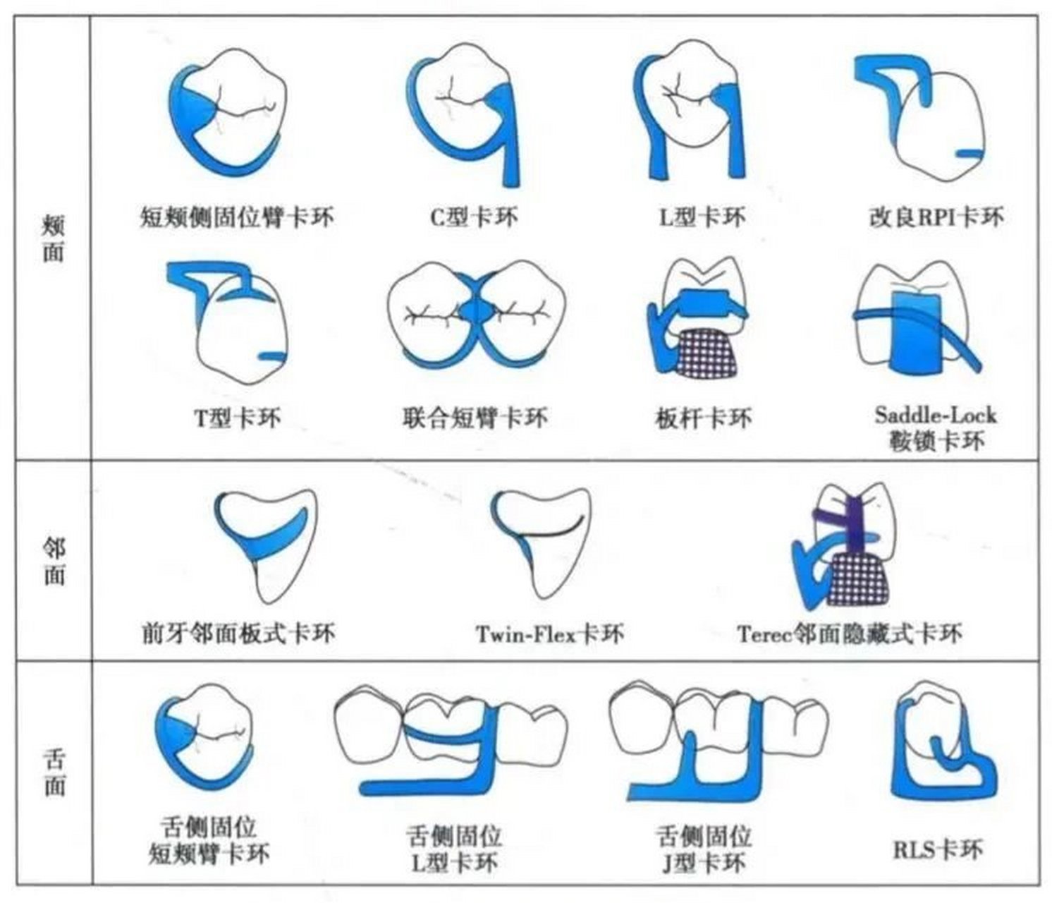 卡环全搞定 卡环的顺口溜 三臂好看最广泛 孤立磨牙套个圈 回力冠短应