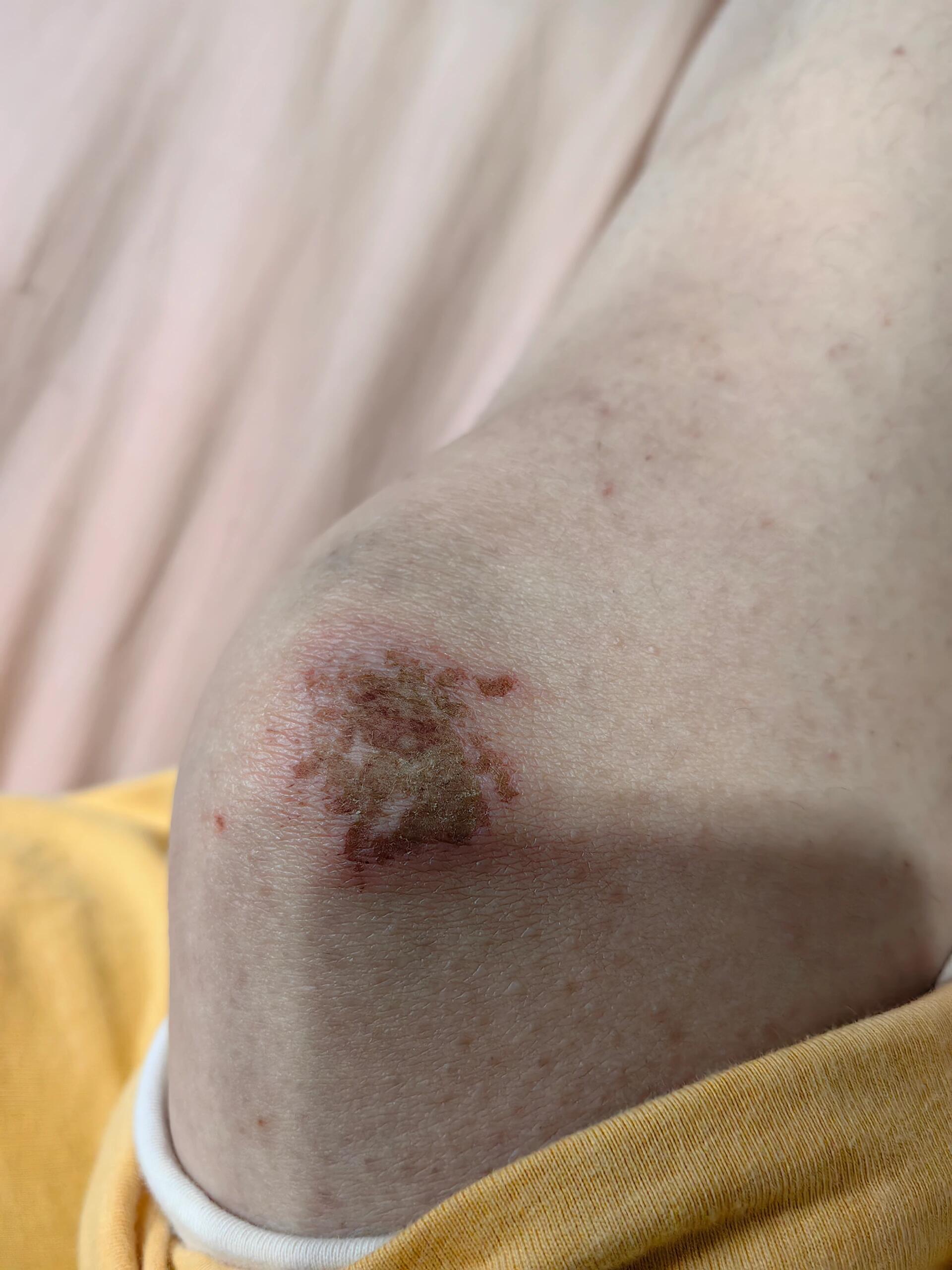 擦伤伤口愈合全过程