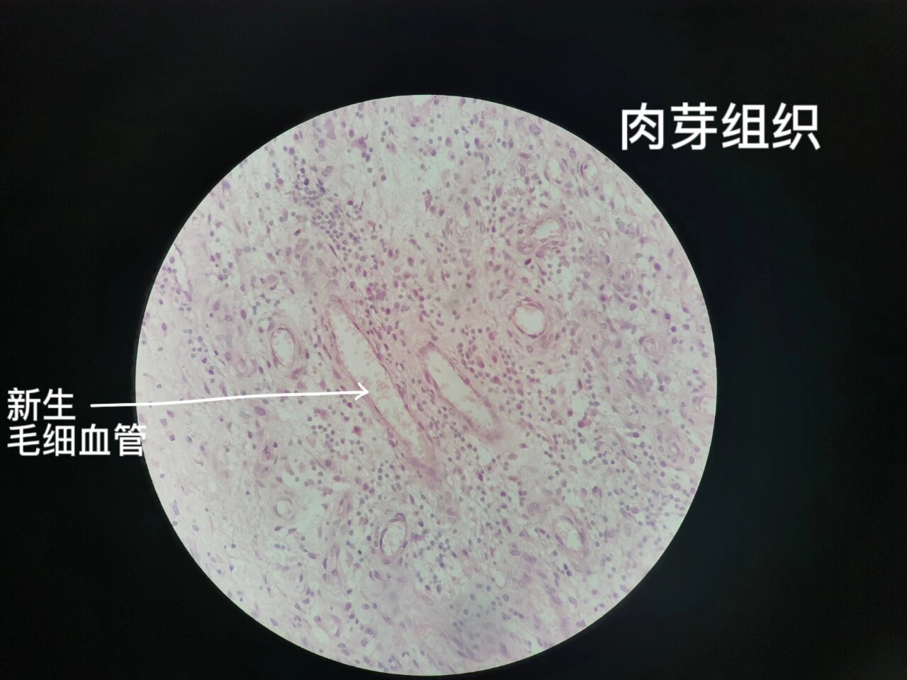 病理学实验报告——肉芽组织