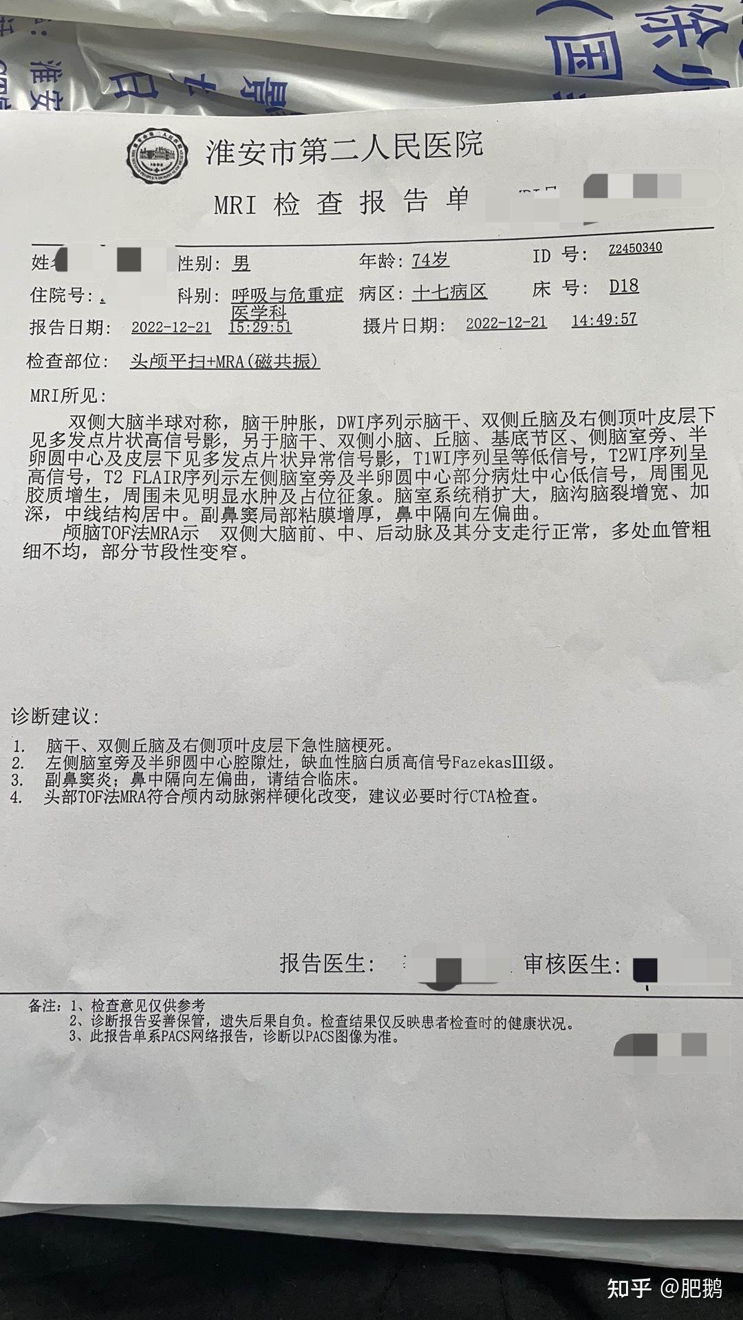 急性脑干梗塞可以醒来吗