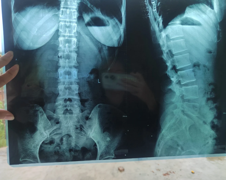 强直性脊柱炎影像学表现主要看哪部分?