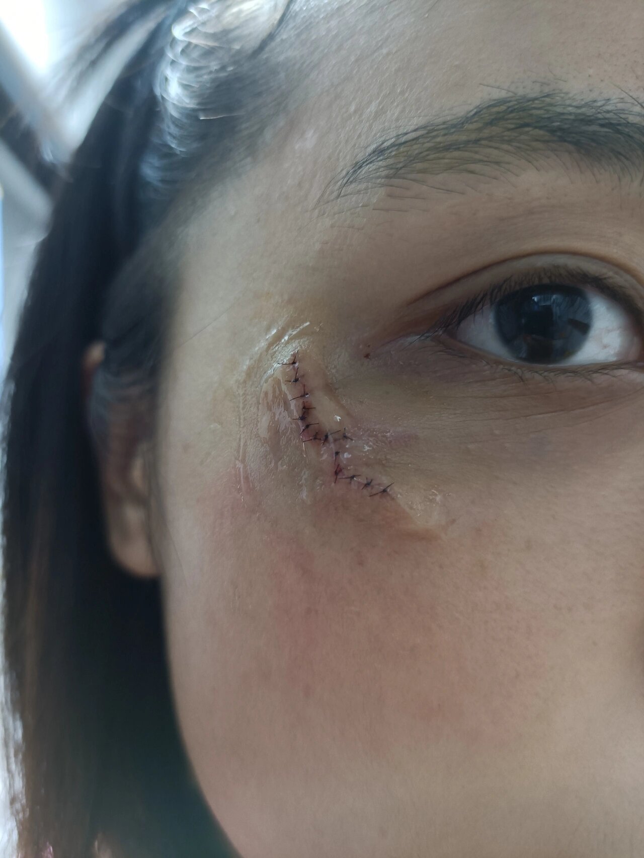 网上看了都说湿性愈合比较