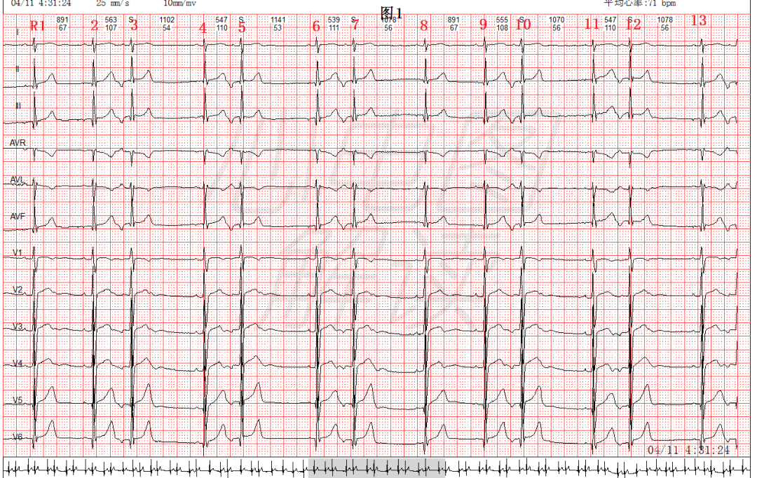 房性早搏二联律逆传p的判断