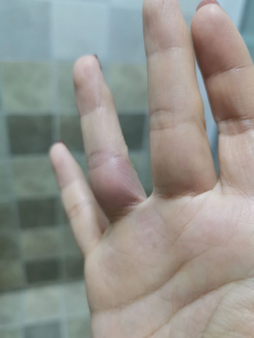 指根发青,不痛不痒,这是怎么回事?