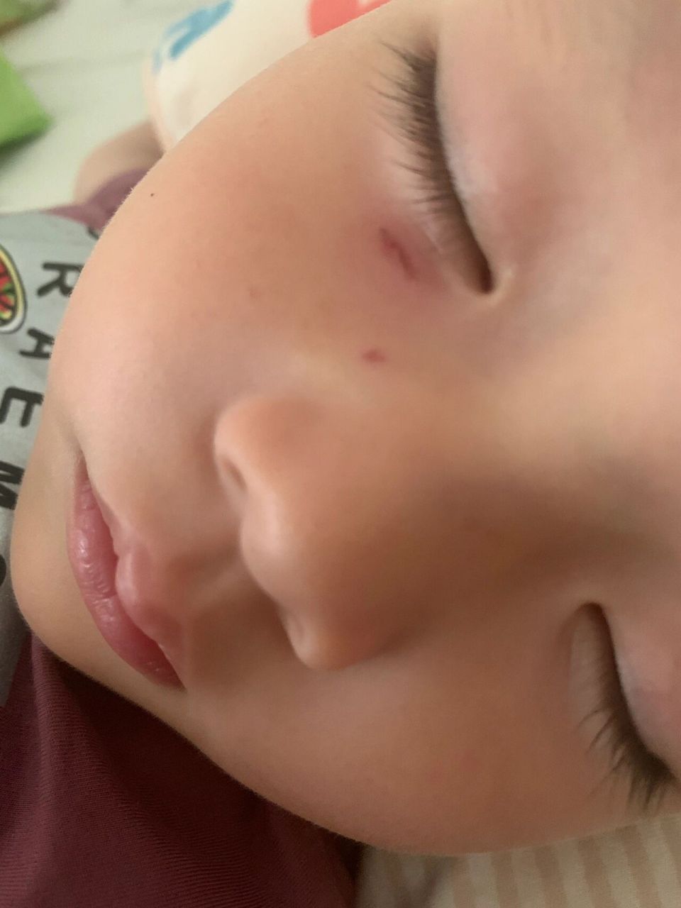 被小孩子抓伤了,能恢复吗?会不会留疤