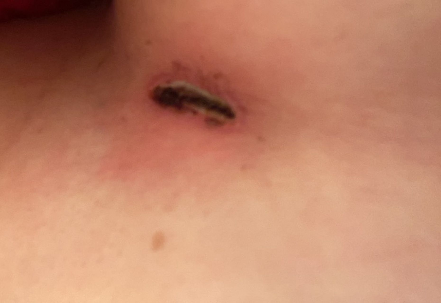 帮我看看我是不是肋骨伤口感染了 拆线的第二天不小心滴到了两滴水