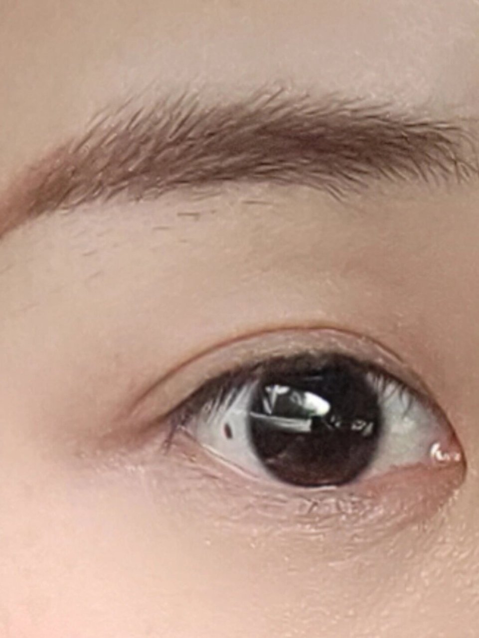 眼珠子里长痣是什么原因