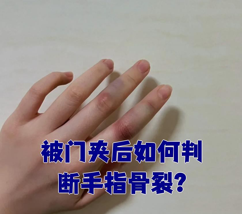手指被门夹后,判断是否骨裂主要看三点:外观变化,活动情况和影像学