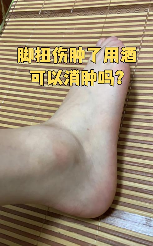 如果是刚扭伤24小时内,不能用酒消肿