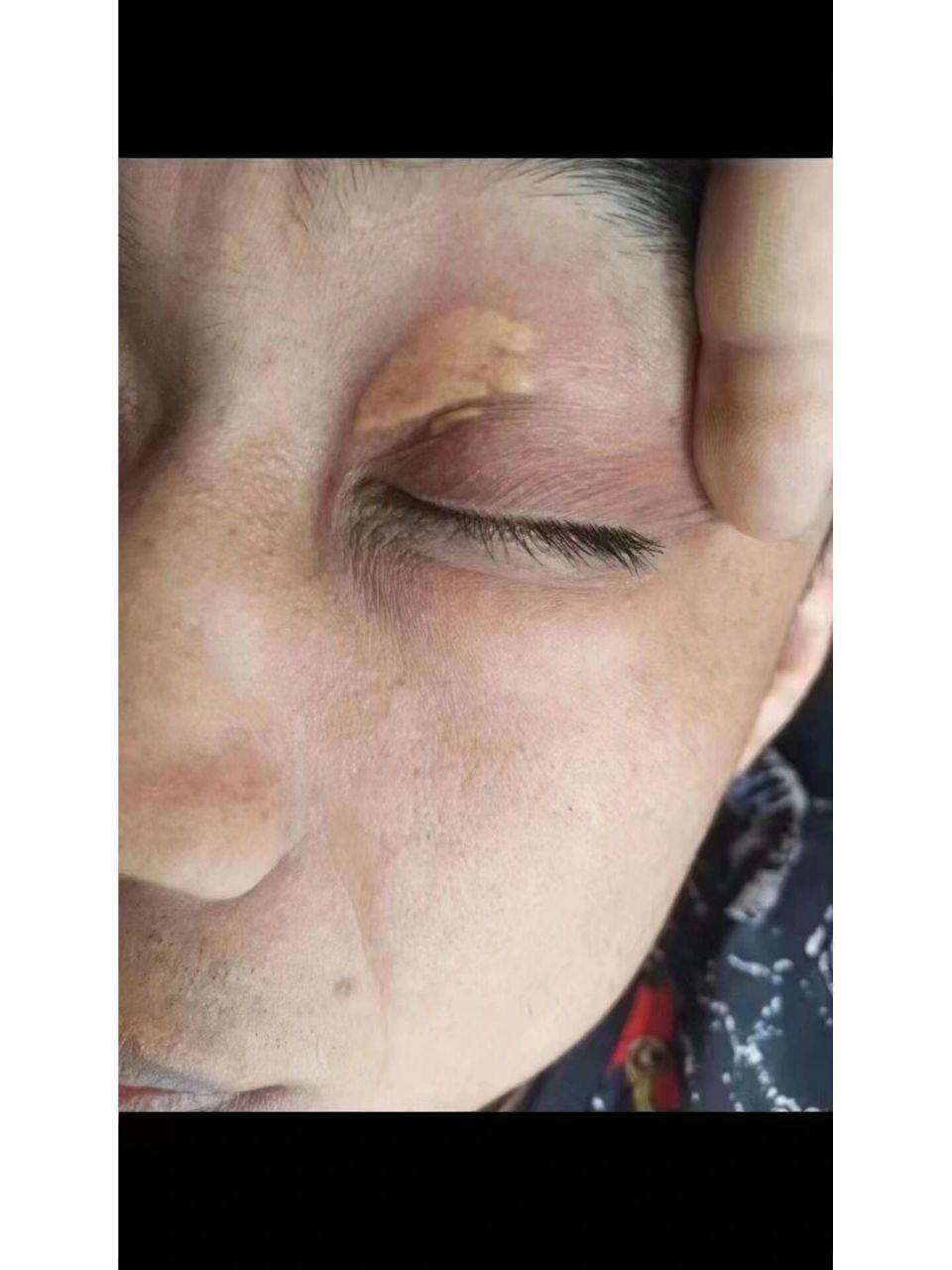 91睑黄疣 91睑黄疣: 1.中年人多见,尤其是女性. 2.