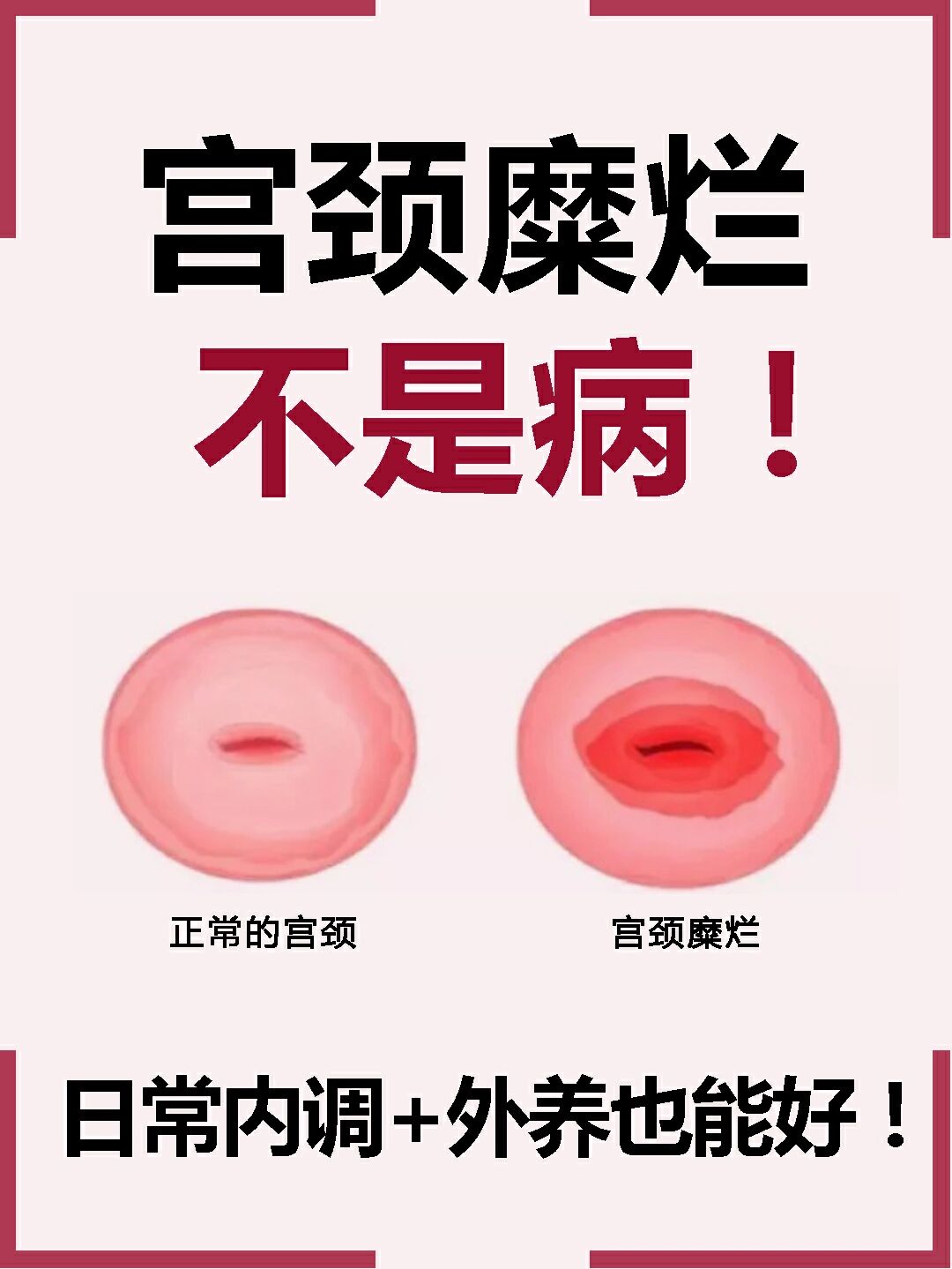 宫颈糜烂不是病!日常内调 外养也能好!