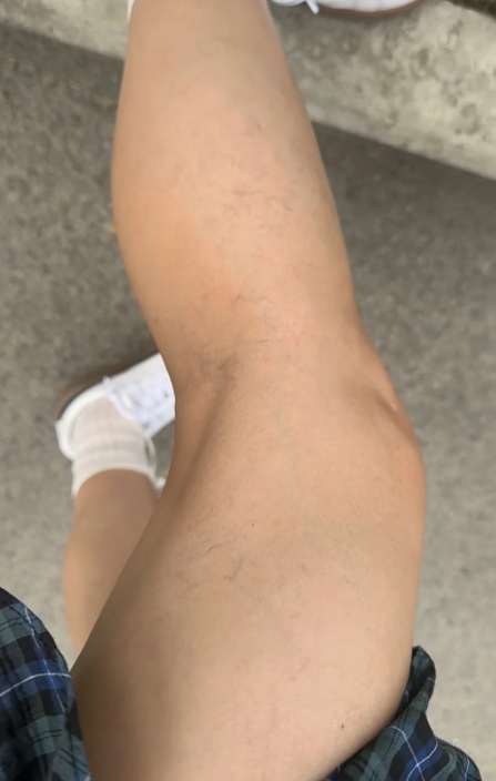 脚背血管明显多为正常生理现象,也可能提示静脉曲张,静脉回流受昨或