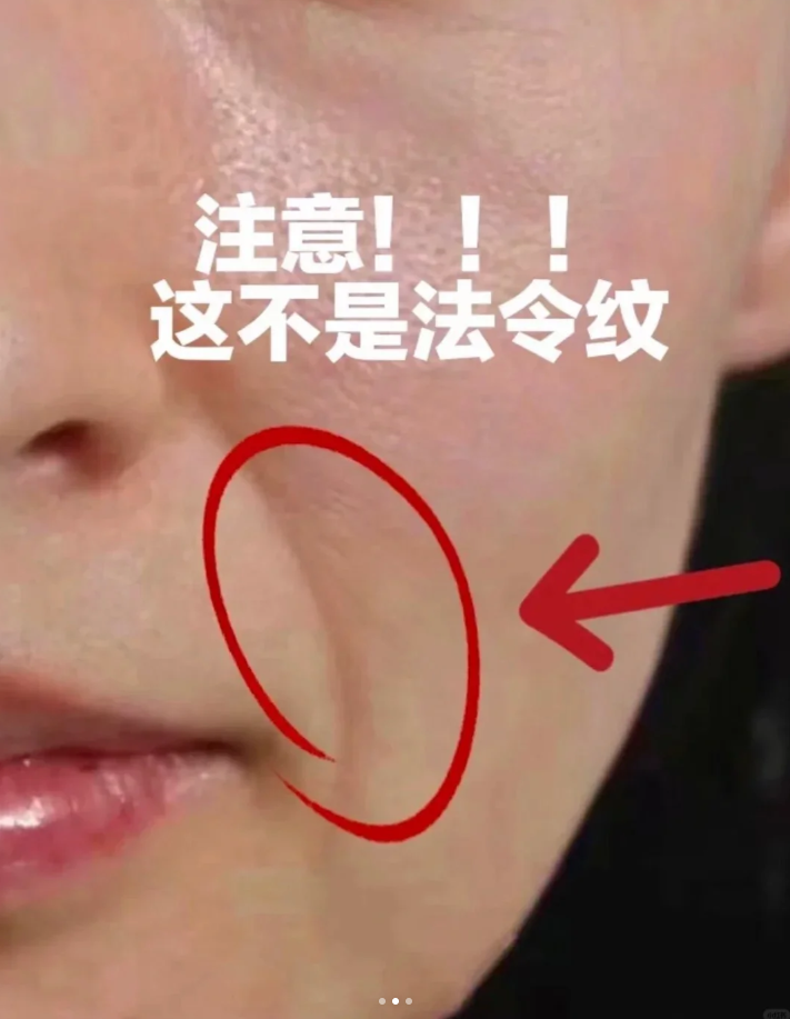 但其实,很多时候我们都被"假性法令纹"给误导了!