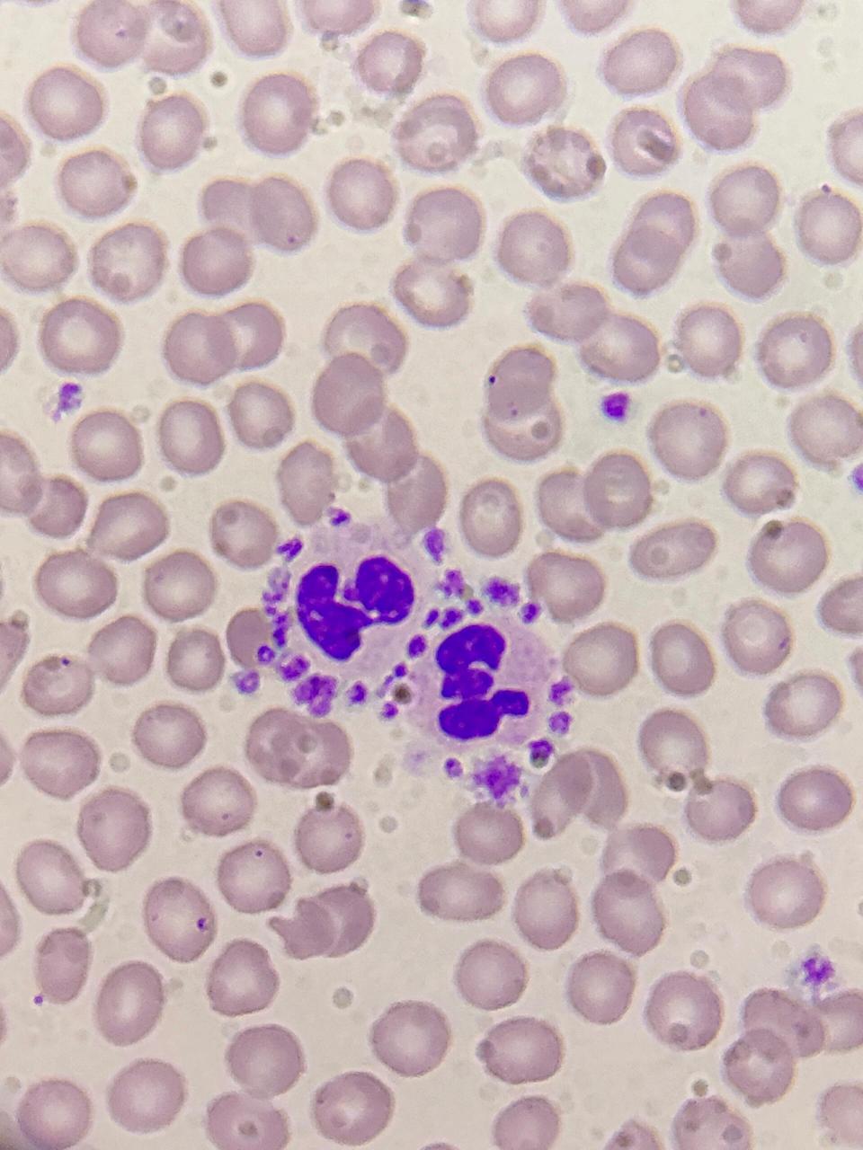 血小板卫星现象959595 97血小板卫星现象:血小板黏附,围绕于