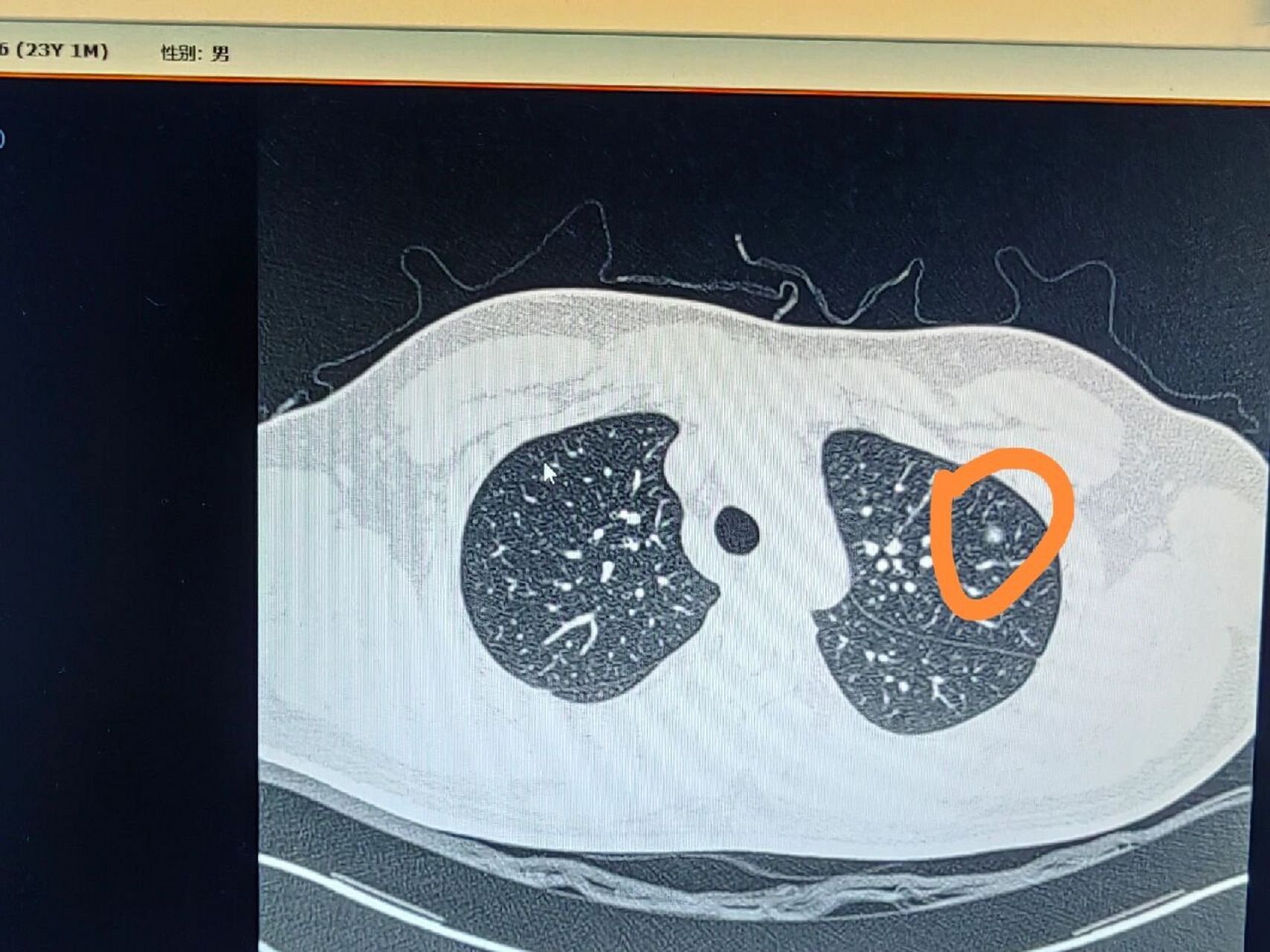 左上肺尖后段磨玻璃结节 相同的部位,一位23岁的男性患者,一位57岁的