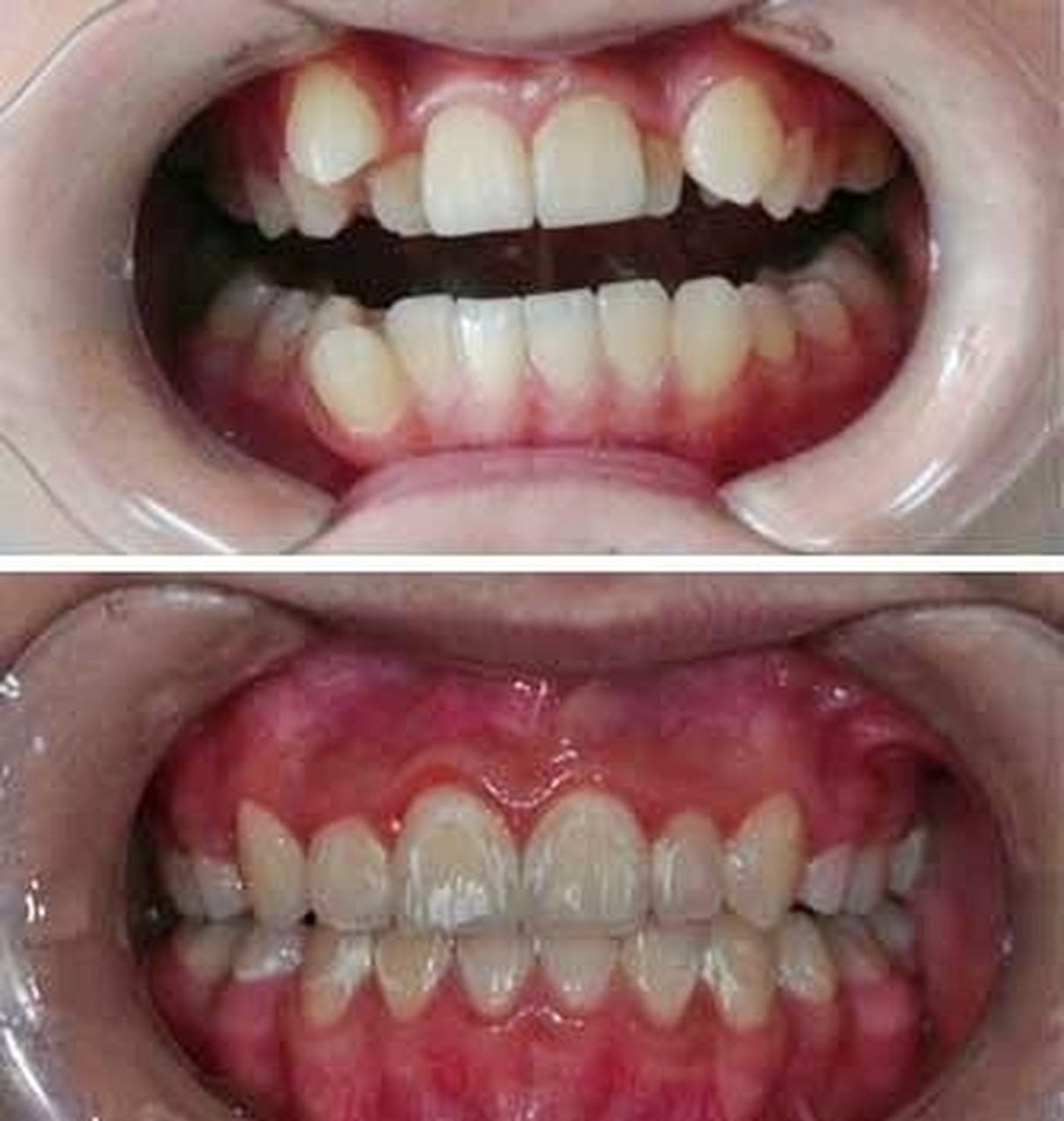 来矫正的顾客,很多都是尖牙突出,也就是人们口中的虎牙长在牙列的