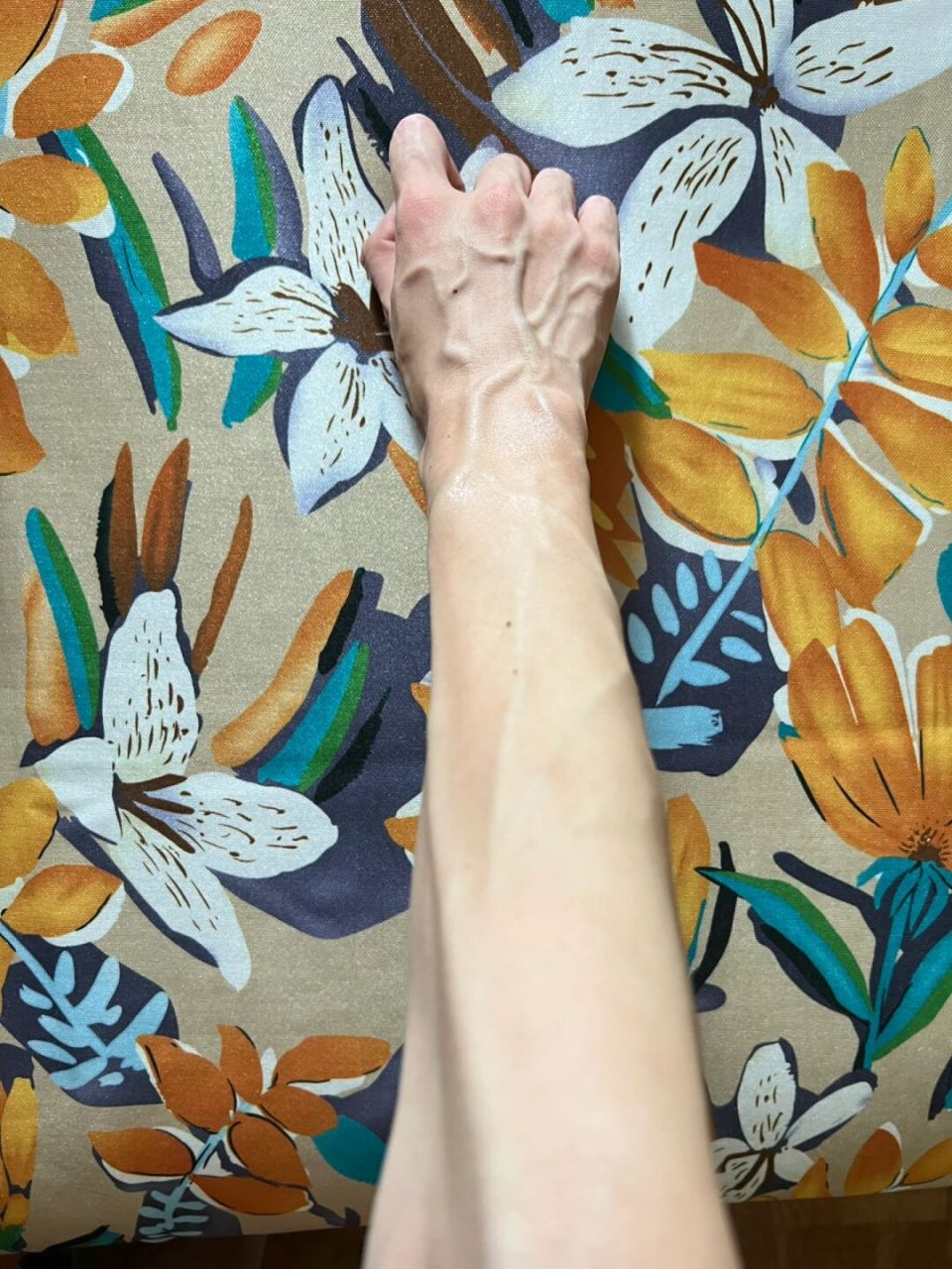 今天人品爆棚 第三张有点惊悚 晒伤后遗症 #佳菲的日常# #晒伤# #青筋