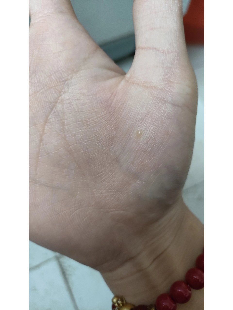 手掌心起了一个透明小水泡,不痛不痒 这个小水泡我搜了下,有人说是