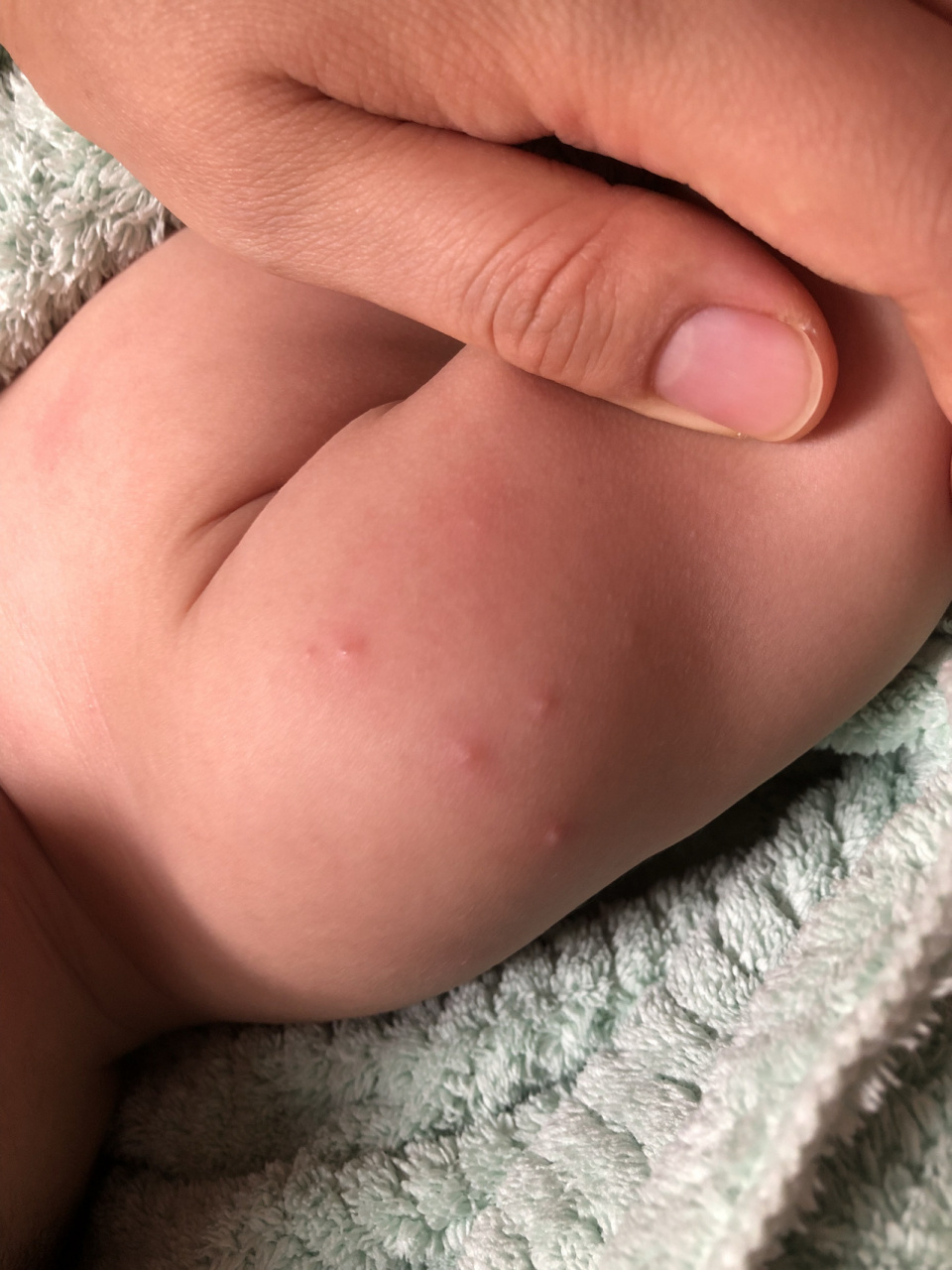 宝宝身上长疹子 宝宝腿上起这样的小包,很痒,这是刚发起来的样子,小腿