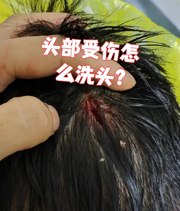 第一种情况是头皮血肿