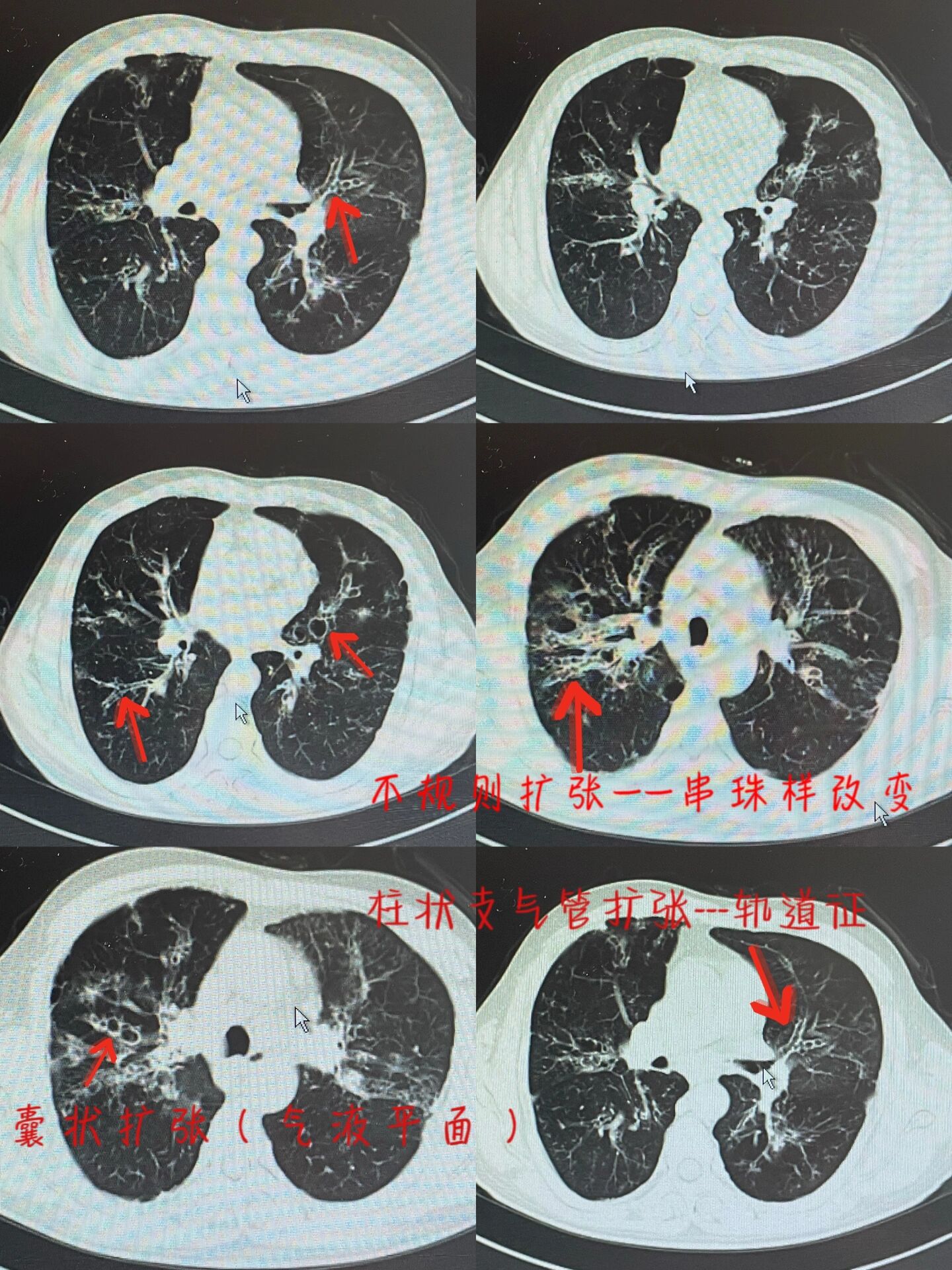 支气管扩张x光图片