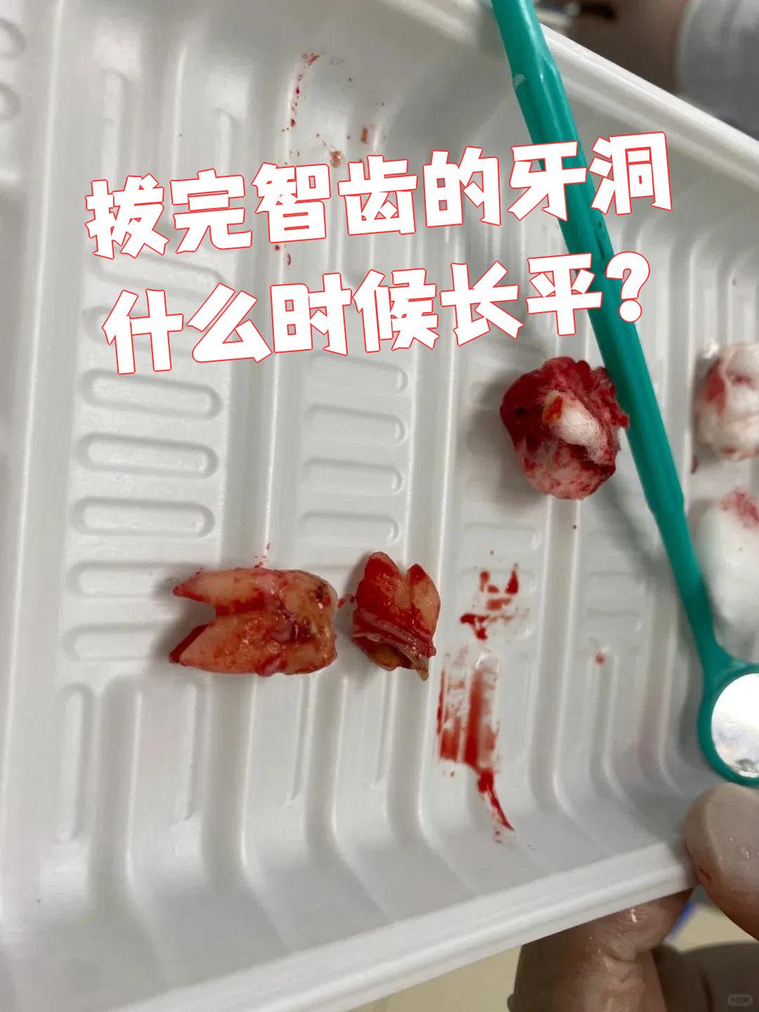 牙洞愈合快慢主要看两点:一是智齿的位置和拔牙难度