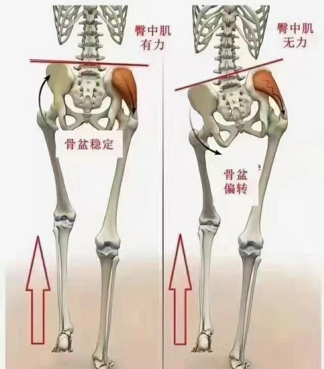 骨盆旋转的危害 1,慢性炎症:骨盆旋转后,会有肌肉,颈膜的牵拉,长期